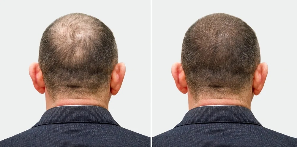 balding