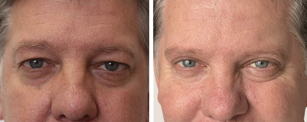 blepharoplasty surgery