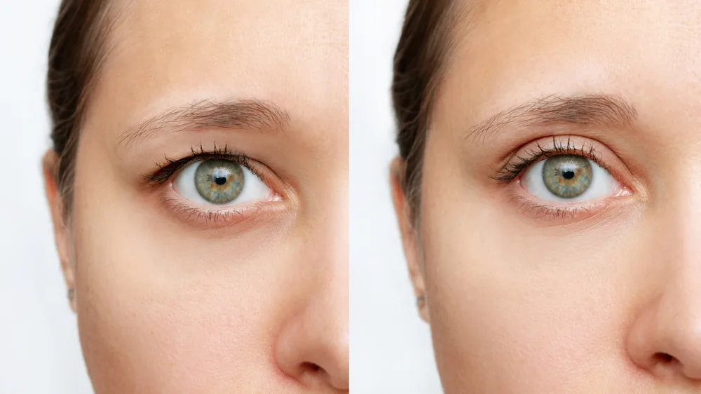 upper blepharoplasty