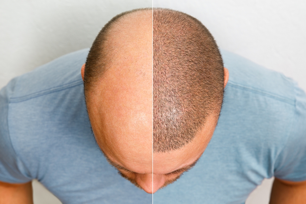 am i going bald test