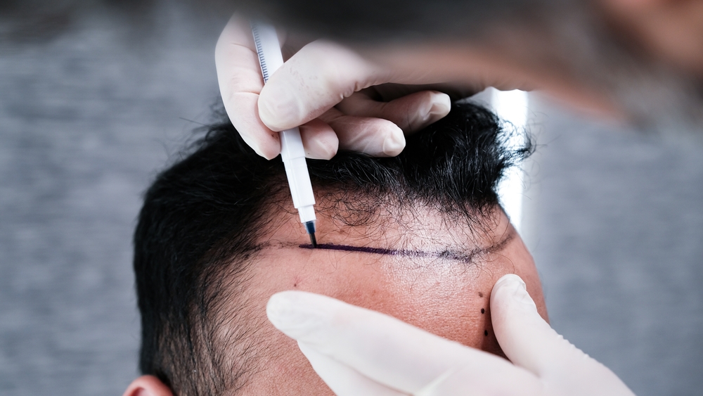 men hair loss solutions
